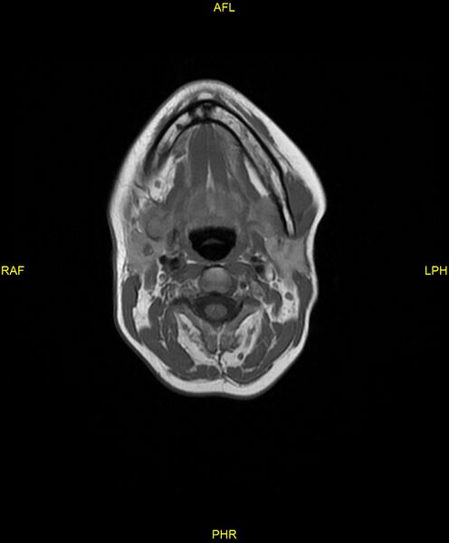File:C5 nerve sheath tumor (Radiopaedia 85777-101596 Axial T1 7).jpg