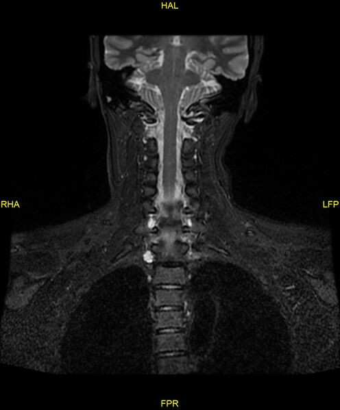 File:C5 nerve sheath tumor (Radiopaedia 85777-101596 Coronal T2 fat sat 13).jpg