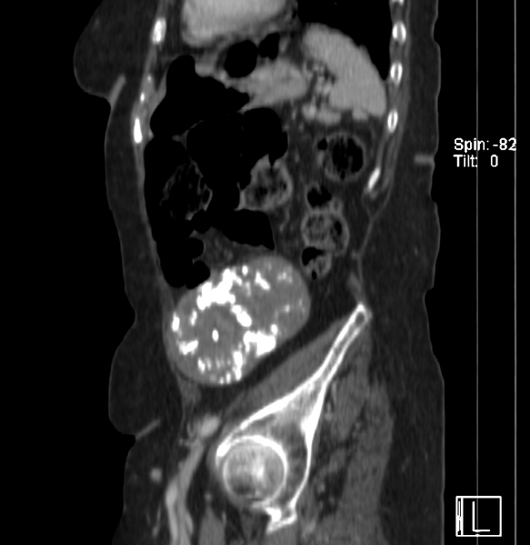 File:Calcified fibroids (Radiopaedia 20306-20228 A 1).png
