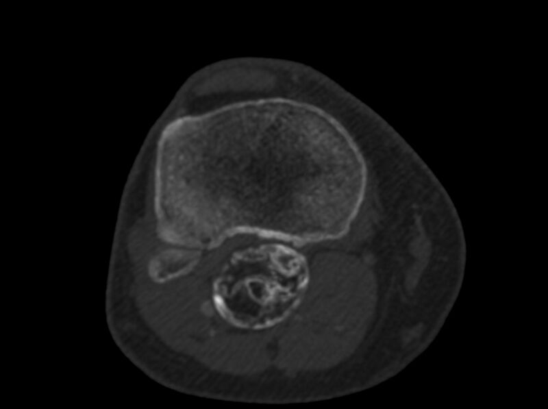File:Calcified hematoma - popliteal fossa (Radiopaedia 63938-72763 C 54).jpg
