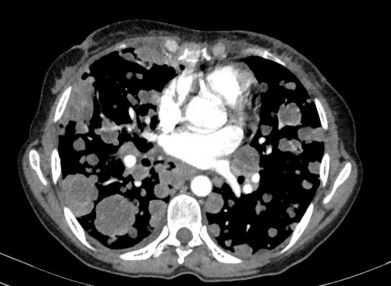 File:Cannonball metastases from breast cancer (Radiopaedia 91024-108569 A 68).jpg