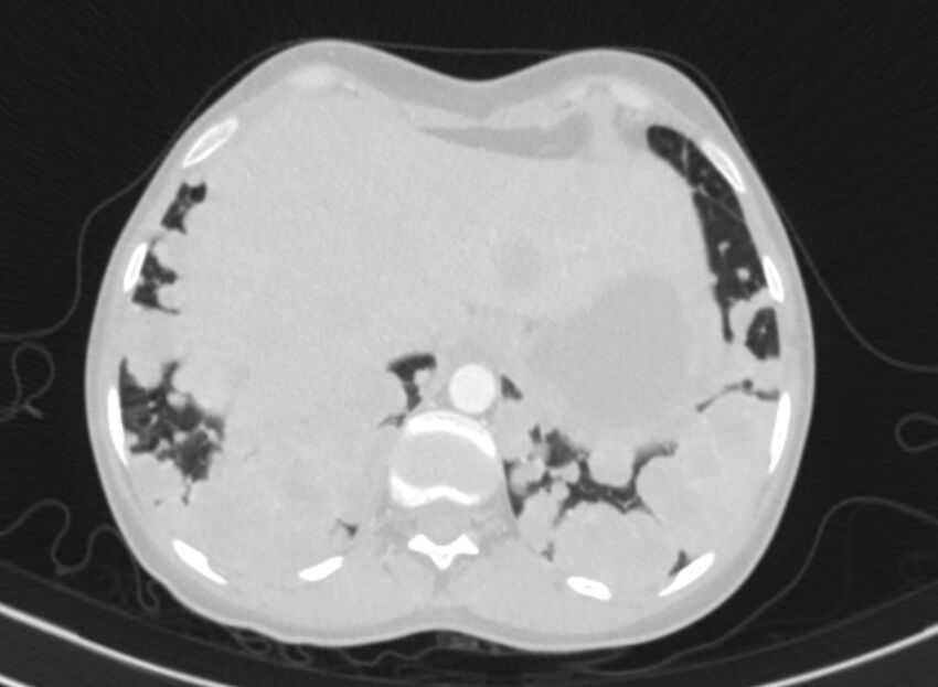 Cannonball metastases from breast cancer (Radiopaedia 91024-108569 Axial lung window 90).jpg