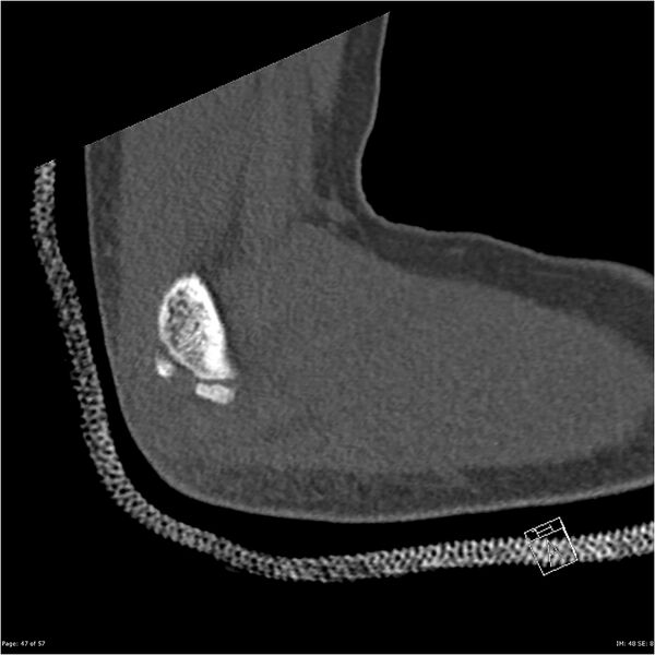 File:Capitellum fracture (Radiopaedia 23352-23426 Sagittal bone window 47).jpg