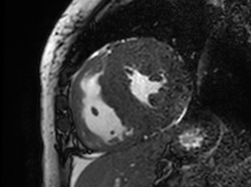 Cardiac amyloidosis (Radiopaedia 61600-69579 Short axis bSSFP 157).jpg