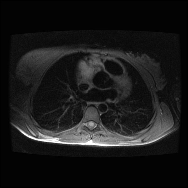 File:Cardiac paraganglioma (Radiopaedia 76345-88009 Axial T1 fat sat 5).jpg