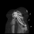 Cardiogenic pulmonary edema (Radiopaedia 29213-29609 Coronal non-contrast 1).jpg