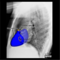 Cardiomediastinal anatomy on chest radiography (annotated images) (Radiopaedia 46331-50772 F 1).png