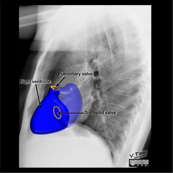 File:Cardiomediastinal anatomy on chest radiography (annotated images) (Radiopaedia 46331-50772 F 1).png