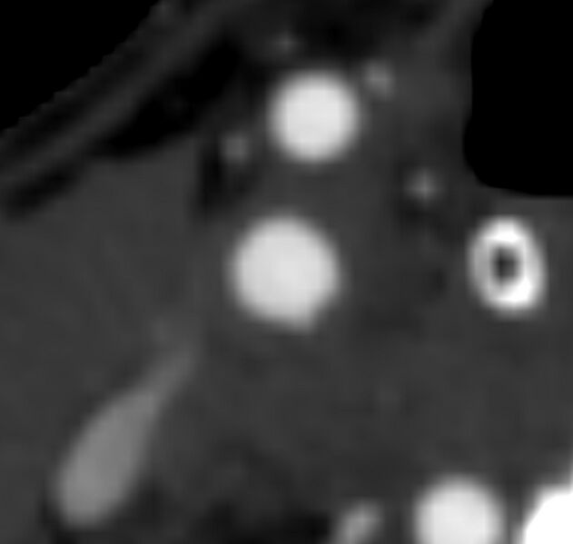 File:Carotid near-occlusion (Radiopaedia 85304-100887 M 52).jpg