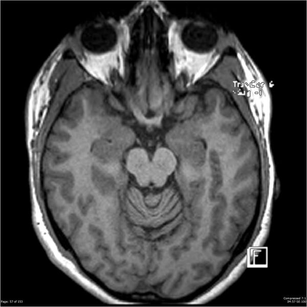 File:Cavernous malformation (cavernous angioma or cavernoma) (Radiopaedia 36675-38237 Axial T1 46).jpg