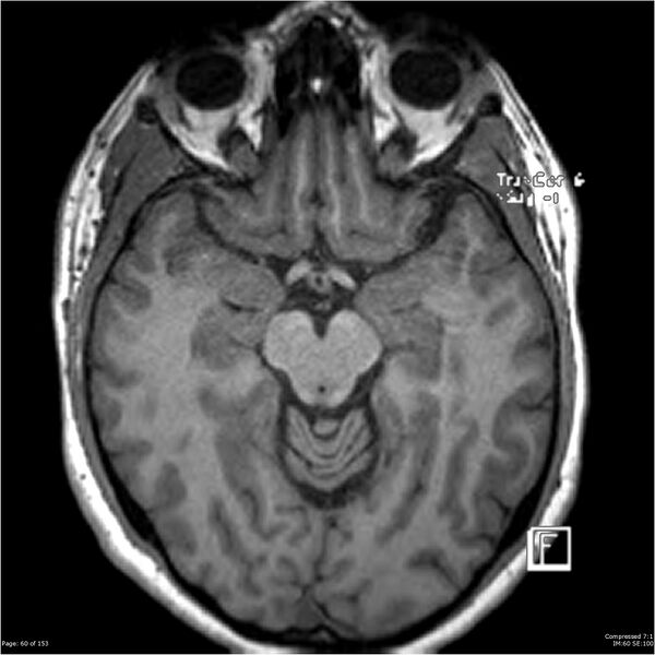 File:Cavernous malformation (cavernous angioma or cavernoma) (Radiopaedia 36675-38237 Axial T1 49).jpg