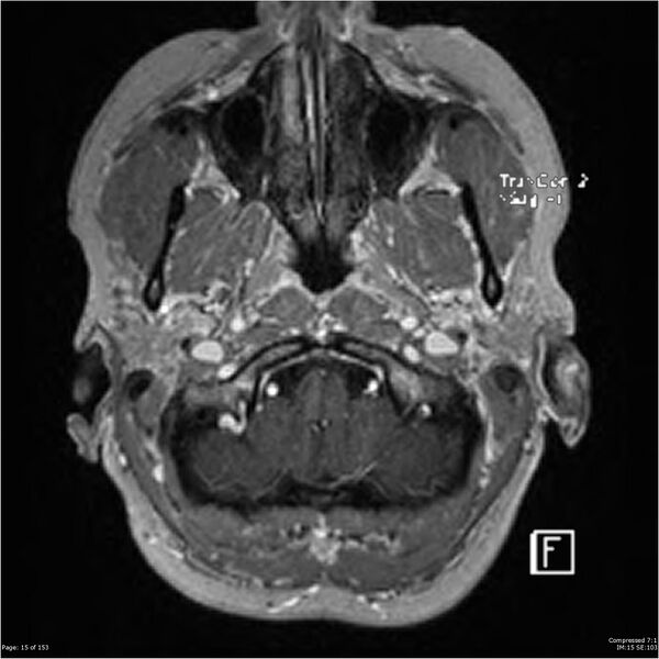 File:Cavernous malformation (cavernous angioma or cavernoma) (Radiopaedia 36675-38237 Axial T1 C+ 8).jpg