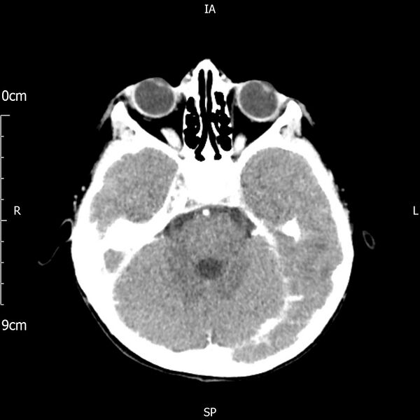 File:Cavernous sinus thrombosis (Radiopaedia 79414-92510 Axial Brain 75).jpg