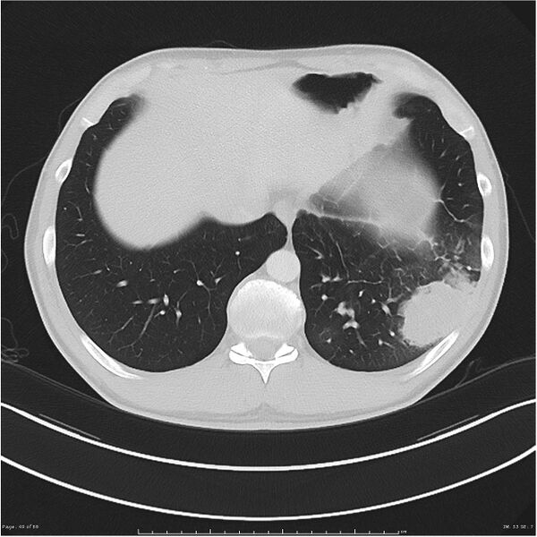 File:Cavitating lung cancer (Radiopaedia 25796-25945 Axial lung window 49).jpg
