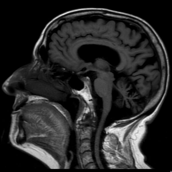 File:Cerebellar ataxia with neuropathy and vestibular areflexia syndrome (CANVAS) (Radiopaedia 74283-85159 Sagittal FLAIR 10).jpg