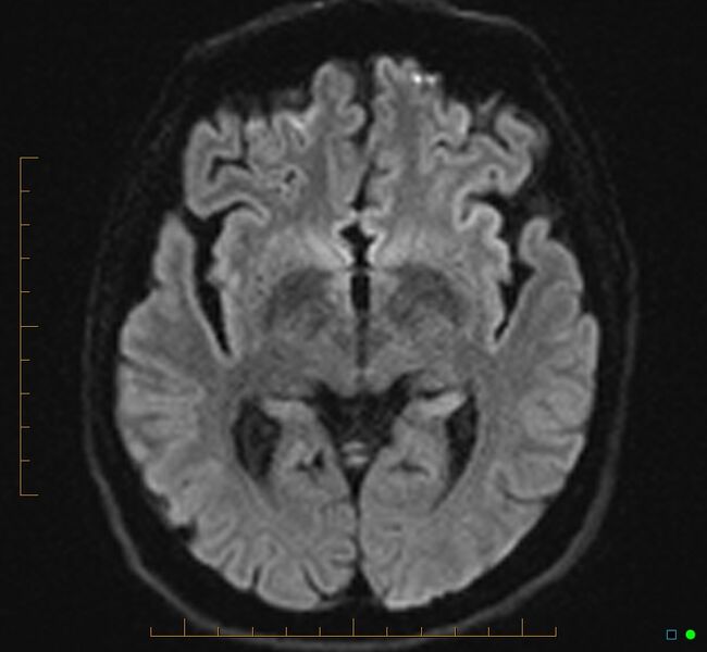 File:Cerebellar gangliocytoma (Radiopaedia 65377-74422 Axial DWI 18).jpg