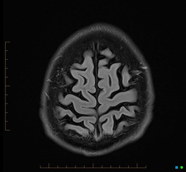 File:Cerebellar gangliocytoma (Radiopaedia 65377-74422 Axial FLAIR 35).jpg