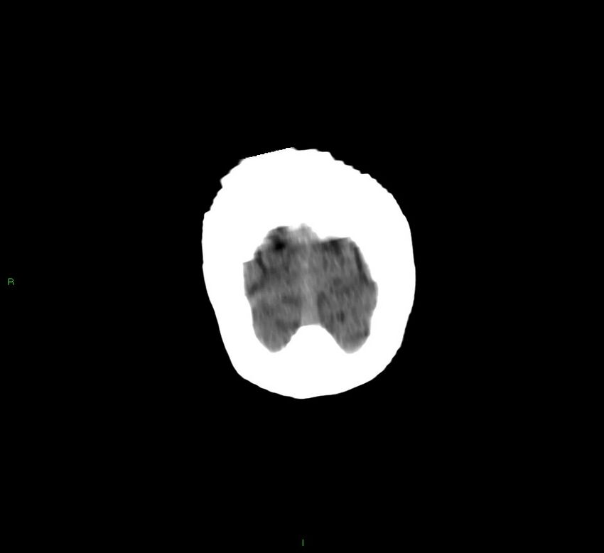 Cerebellar hemorrhage (Radiopaedia 58792-66026 Coronal non-contrast 6).jpg