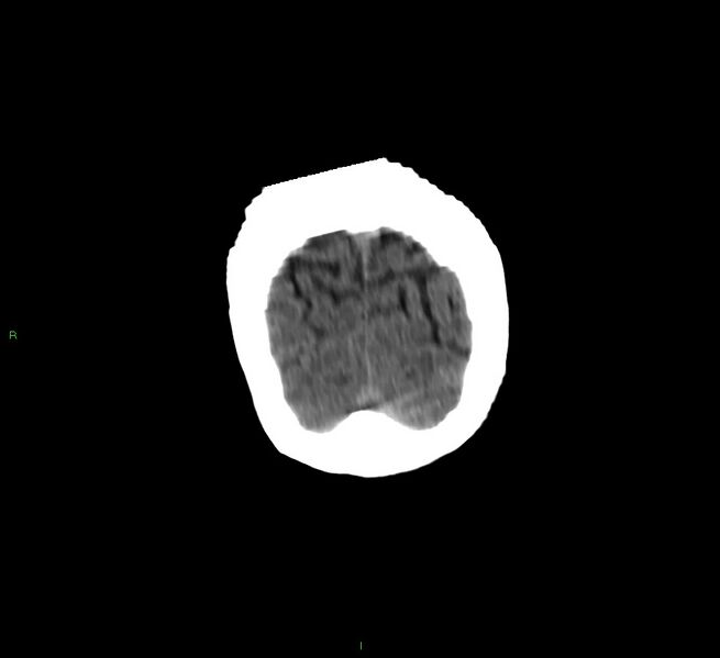 File:Cerebellar hemorrhage (Radiopaedia 58792-66026 Coronal non-contrast 8).jpg