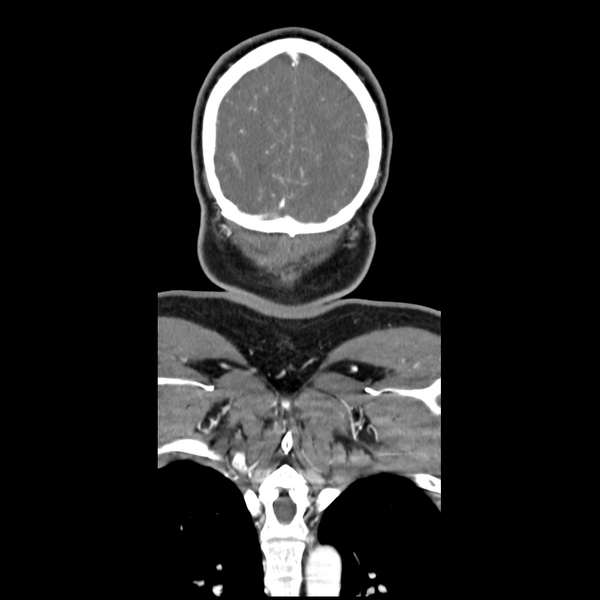 File:Cerebellar infarct due to vertebral artery dissection with posterior fossa decompression (Radiopaedia 82779-97029 D 57).png