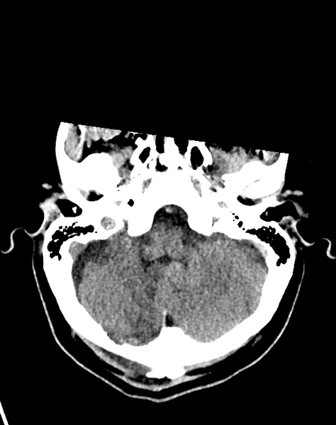 File:Cerebellar infarct due to vertebral artery dissection with posterior fossa decompression (Radiopaedia 82779-97033 Axial non-contrast 9).png