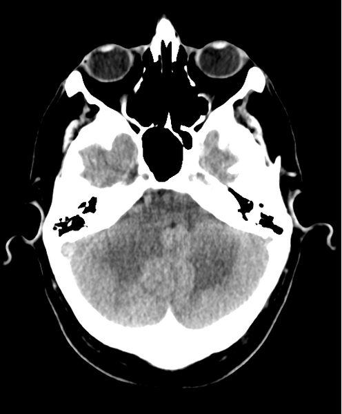 File:Cerebellar metastasis from lung adenocarcinoma (Radiopaedia 86690-102828 Axial non-contrast 7).png