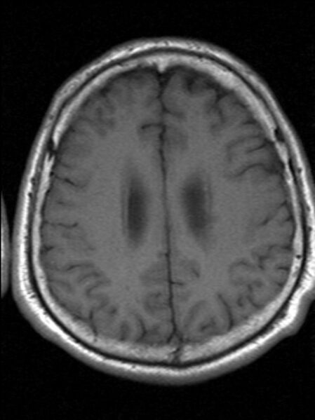 File:Cerebellopontine angle meningioma (Radiopaedia 24459-24764 Axial T1 17).jpg