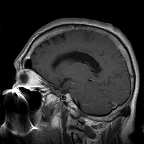 File:Cerebellopontine angle meningioma (Radiopaedia 24459-24764 Sagittal T1 C+ 16).jpg