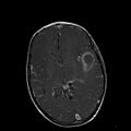 Cerebral abscess post cardiac surgery (Radiopaedia 27244-27420 Axial T1 C+ 10).jpg