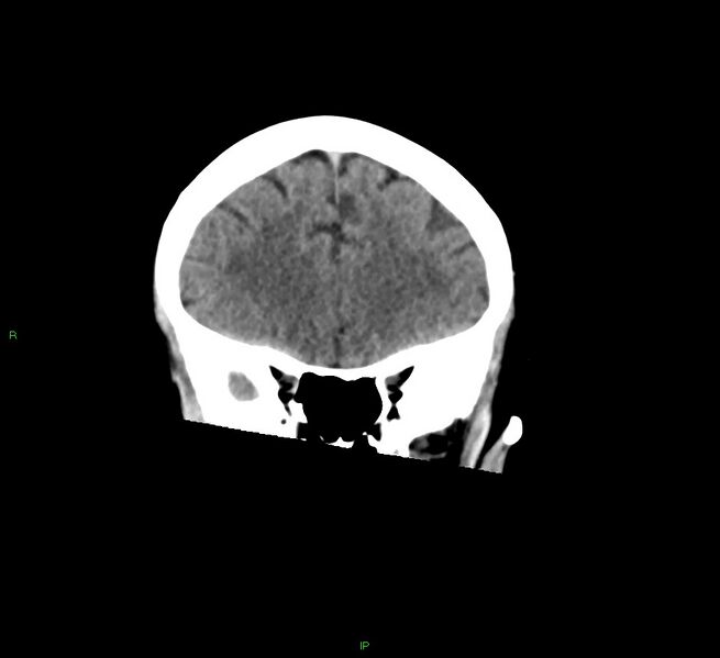 File:Cerebral amyloid angiopathy-associated lobar intracerebral hemorrhage (Radiopaedia 58378-65516 Coronal non-contrast 45).jpg