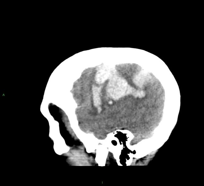 File:Cerebral amyloid angiopathy-associated lobar intracerebral hemorrhage (Radiopaedia 58379-65519 C 10).jpg