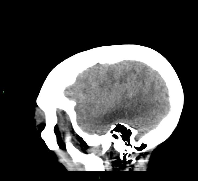 File:Cerebral amyloid angiopathy-associated lobar intracerebral hemorrhage (Radiopaedia 58379-65519 C 43).jpg