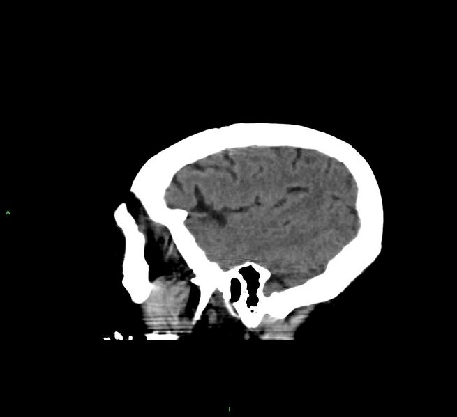 File:Cerebral amyloid angiopathy-associated lobar intracerebral hemorrhage (Radiopaedia 58560-65723 C 43).jpg