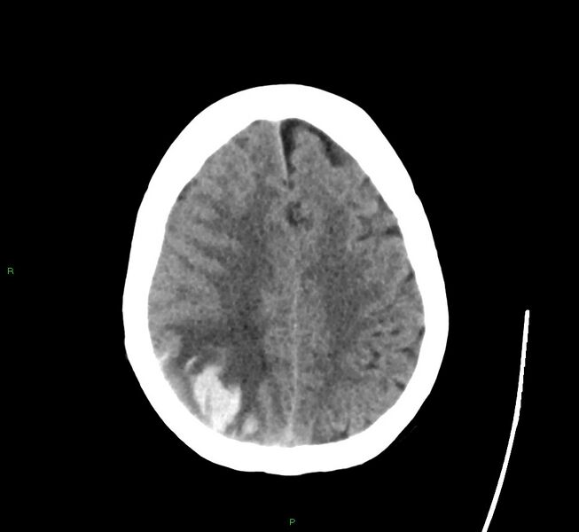 File:Cerebral amyloid angiopathy-associated lobar intracerebral hemorrhage (Radiopaedia 58563-65727 Axial non-contrast 17).jpg