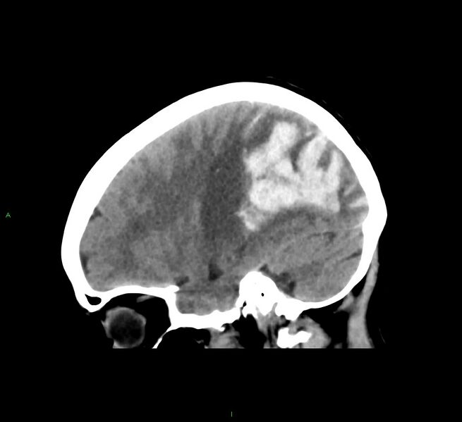 File:Cerebral amyloid angiopathy-associated lobar intracerebral hemorrhage (Radiopaedia 58563-65727 C 19).jpg