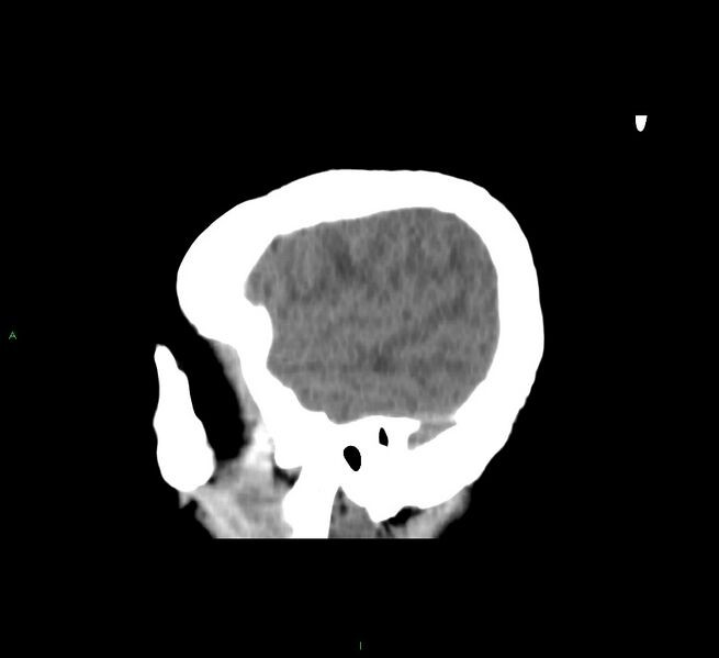 File:Cerebral amyloid angiopathy-associated lobar intracerebral hemorrhage (Radiopaedia 58751-65972 C 45).jpg