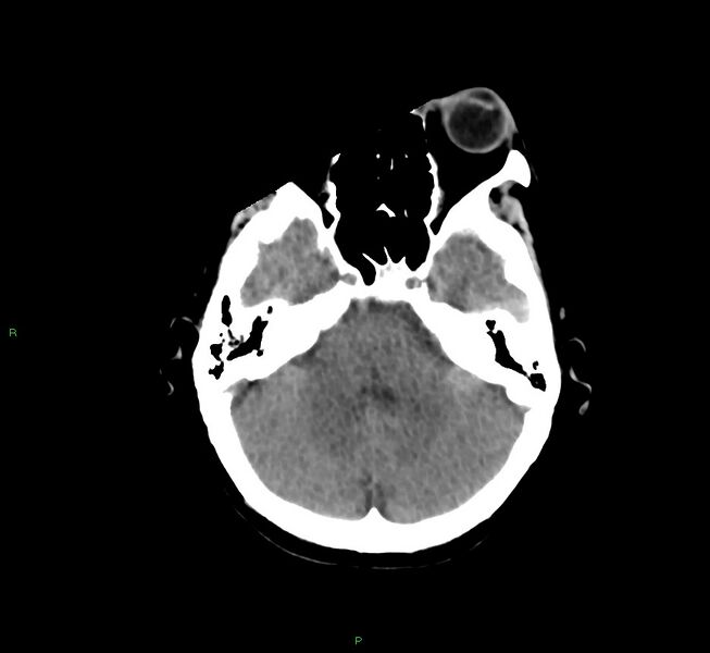 File:Cerebral amyloid angiopathy-associated lobar intracerebral hemorrhage (Radiopaedia 58754-65975 Axial non-contrast 45).jpg