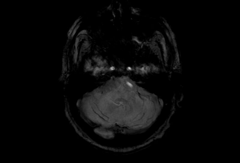 File:Cerebral amyloid angiopathy (Radiopaedia 86671-102792 Axial Gradient Echo 44).jpg
