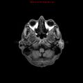 Cerebral and orbital tuberculomas (Radiopaedia 13308-13311 Axial T1 4).jpg