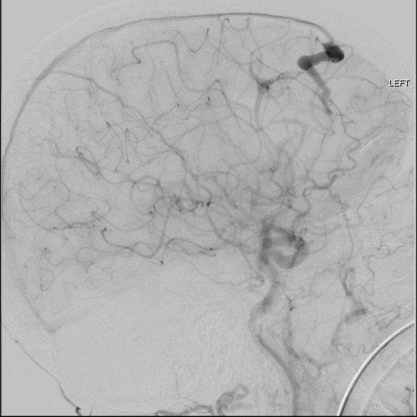 File:Cerebral arteriovenous malformation with lobar hemorrhage (Radiopaedia 44725-48513 LT CCA IC 38).png