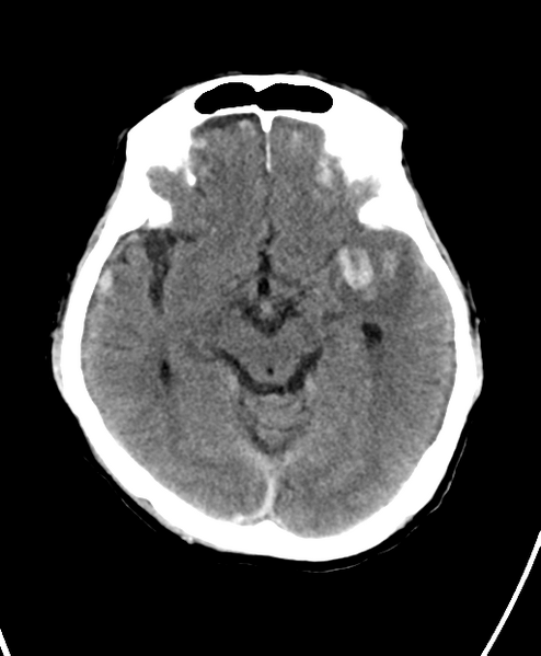 File:Cerebral contusions, subarachnoid hemorrhage and subdural hygromas (Radiopaedia 55399-61828 Axial non-contrast 12).png