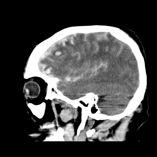 File:Cerebral hemorrhagic contusions (Radiopaedia 23145-23188 C 33).jpg