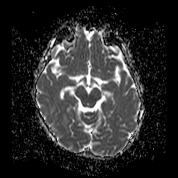 File:Cerebral tuberculoma (Radiopaedia 41152-43932 Axial ADC 9).jpg