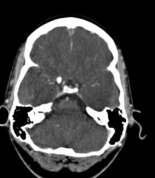 File:Cerebral venous sinus thrombosis (Radiopaedia 59224-66646 Axial C+ delayed 39).jpg