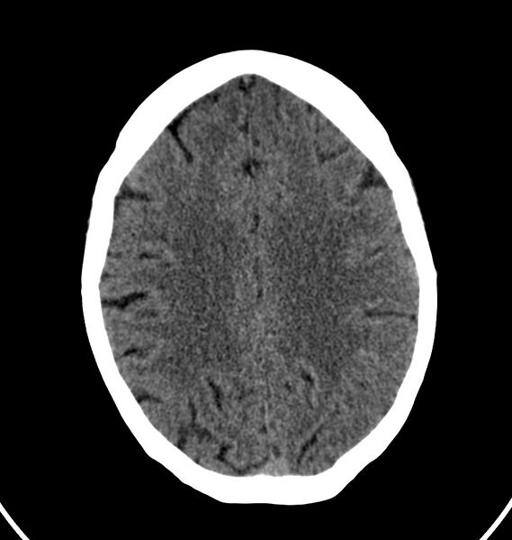 File:Cerebral venous thrombosis - CT only (Radiopaedia 41031-43778 Axial non-contrast 26).jpg