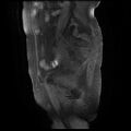 Cervical carcinoma (Radiopaedia 78847-91705 Sagittal T1 fat sat 4).jpg