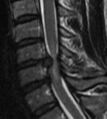 Cervical disc herniation with spinal cord compression (Radiopaedia 14353-14266 T2 1).jpg