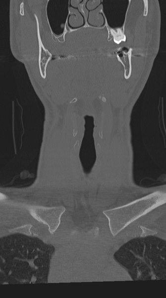 File:Cervical intercalary bone (Radiopaedia 35211-36748 Coronal bone window 6).png