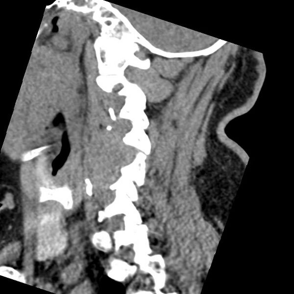 File:Cervical spinal neurofibroma in a patient with NF1 (Radiopaedia 58344-65464 C 17).jpg