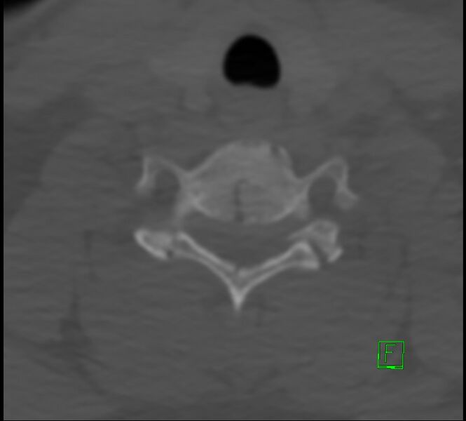 File:Cervical spine fracture - hyperflexion injury (Radiopaedia 66184-75364 Axial bone window 40).jpg